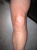 Left leg knee pain.jpg