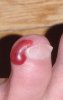 blood blister first day.jpg
